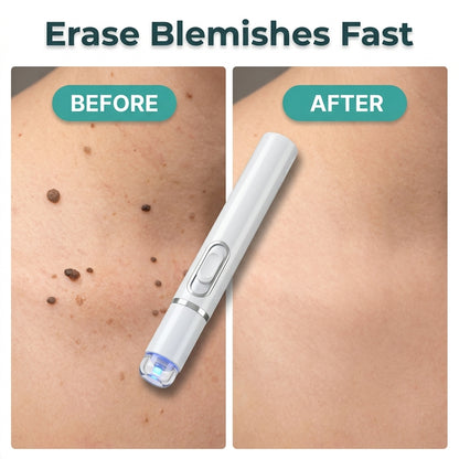 Laser Skin Tag Remover — Targets Spots, Tags & Blemishes From Home