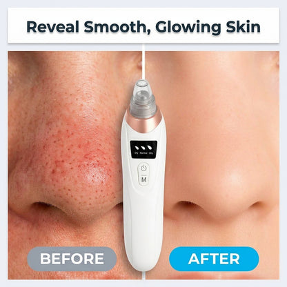 Blackhead Remover Vacuum - Clear Pores