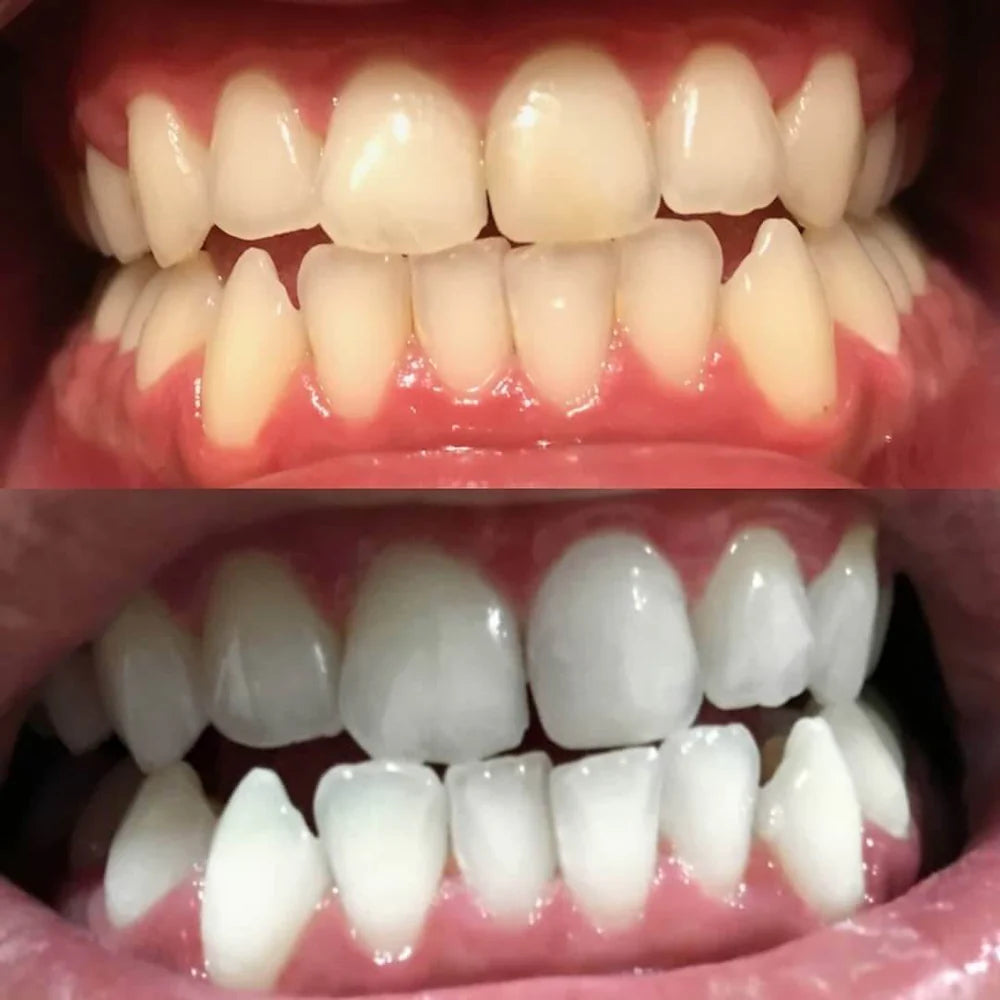 Color Correcting Teeth Pen - Confident Looking Smiles Without Harsh Whitening