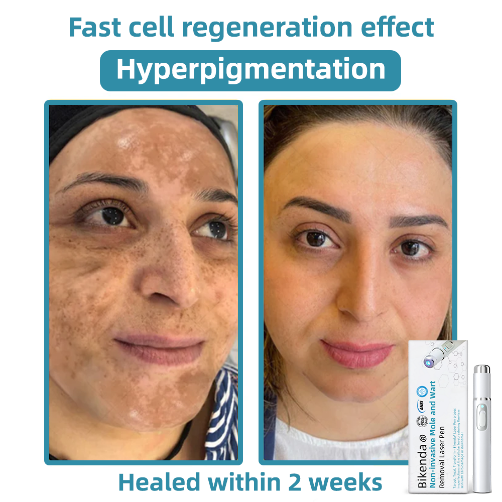 DermaZap® | Professional CO₂ Laser Pen for Flawless Skin at Home