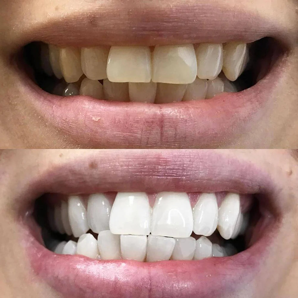 Color Correcting Teeth Pen - Confident Looking Smiles Without Harsh Whitening