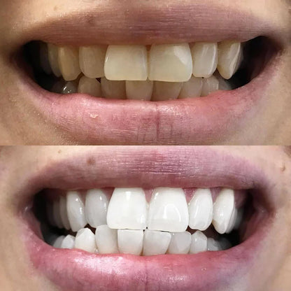Color Correcting Teeth Pen - Confident Looking Smiles Without Harsh Whitening