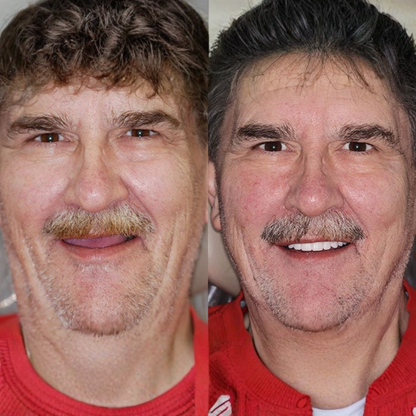 Zvykle tvarované zubní protézy - Sebevědomí bez volných protéz